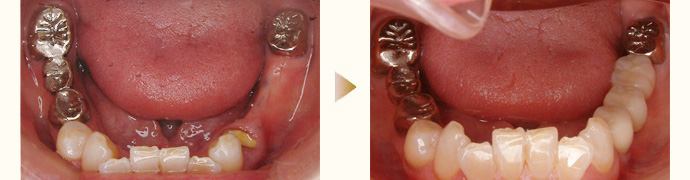 インプラント症例